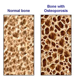 bone density301